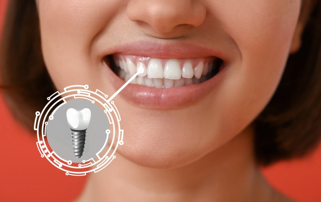 Dental Implantologist in Andheri West